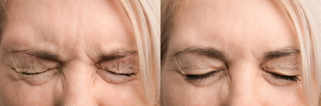 rejuvenecimiento de la piel